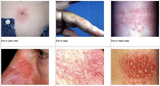 Nickel allergy dermatitis - Corrosion Doctors
